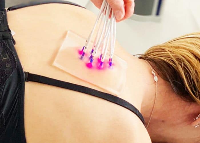 Physiomax Wettingen Physiotherapie Laser Dry Needling moderne Akkupunktur
